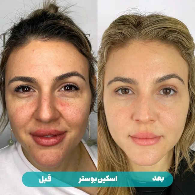 قبل بعد اسکین بوستر مزوژل