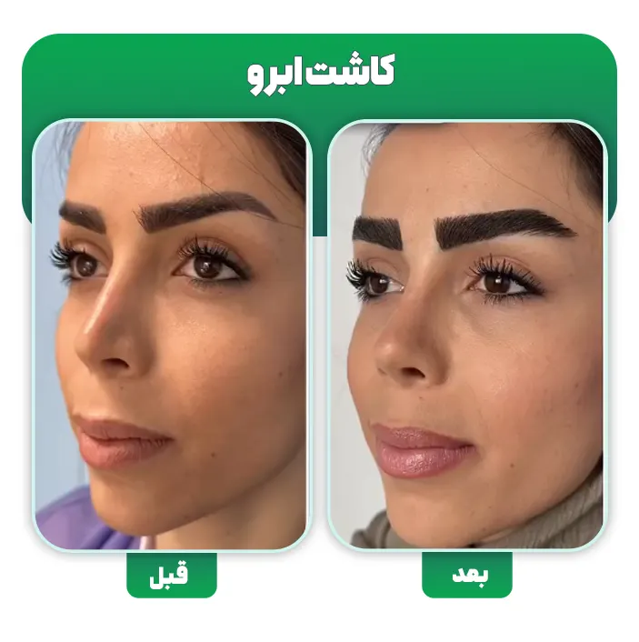 کاشت ابرو به روش DHI