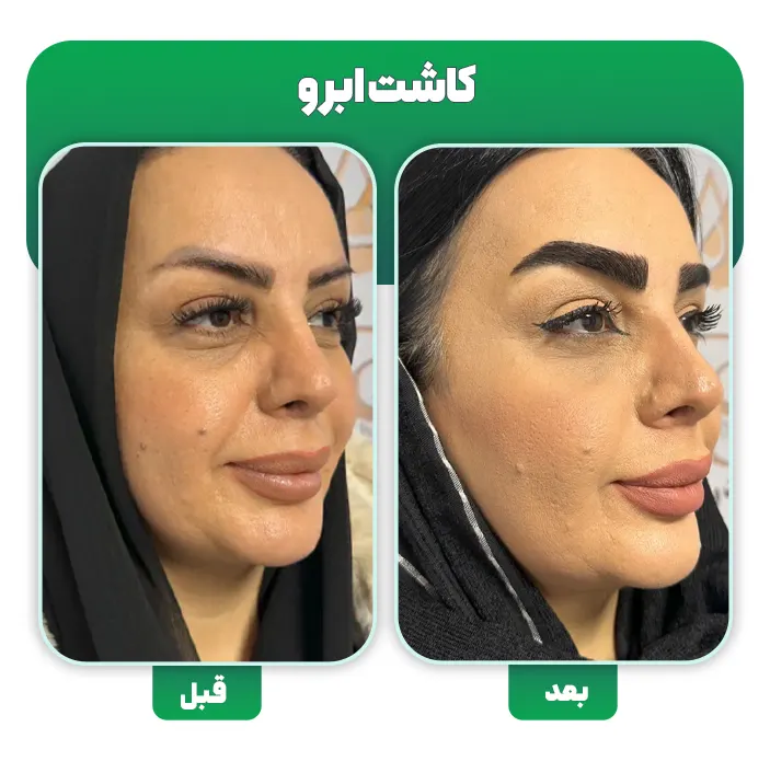 کاشت ابرو به روش DHI