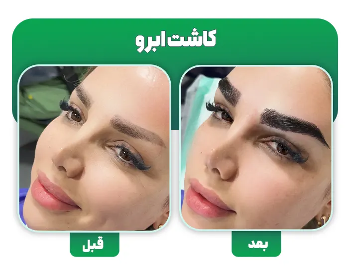 کاشت ابرو به روش DHI