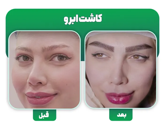 کاشت ابرو به روش DHI