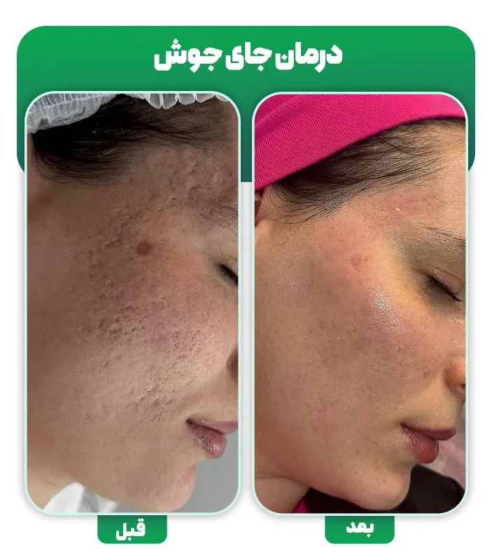 قبل و بعد درمان جای جوش با میکرونیدلینگ