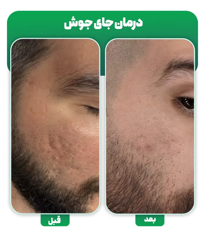 درمان اسکار جای جوش با میکرونیدلینگ