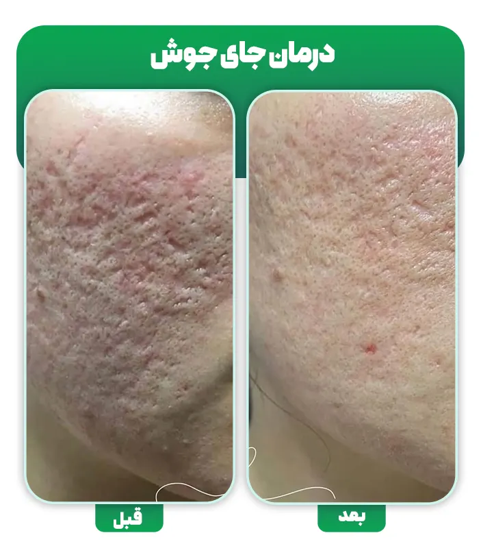 قبل و بعد درمان جای جوش با میکرونیدلینگ
