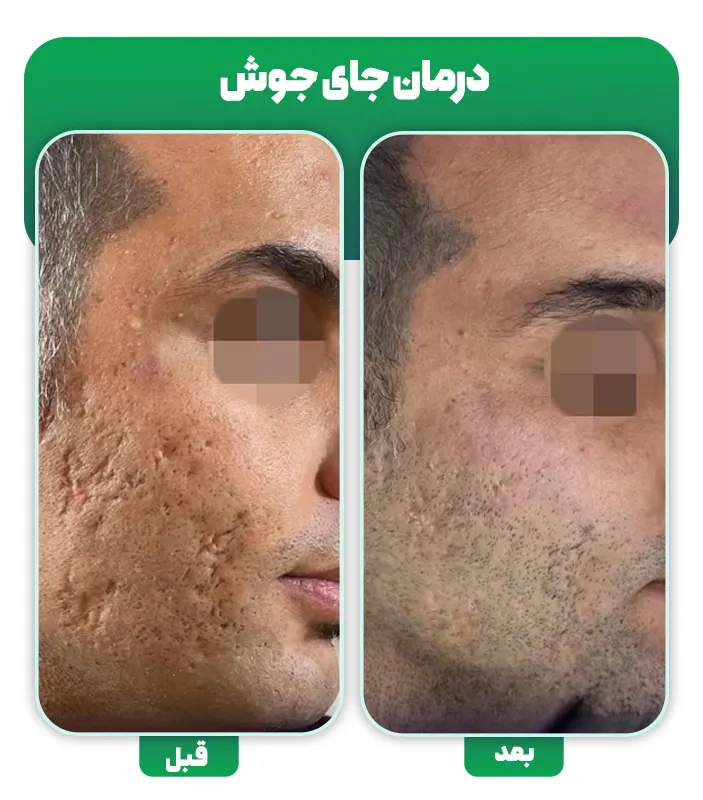 قبل و بعد درمان جای جوش با میکرونیدلینگ