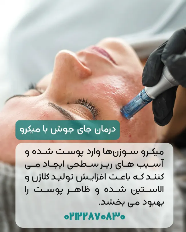 درمان جای جوش با میکرونیدلینگ