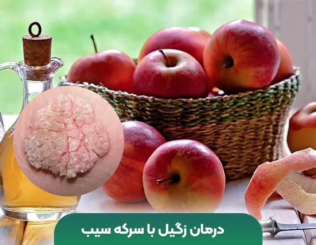 درمان زگیل سرکه سیب