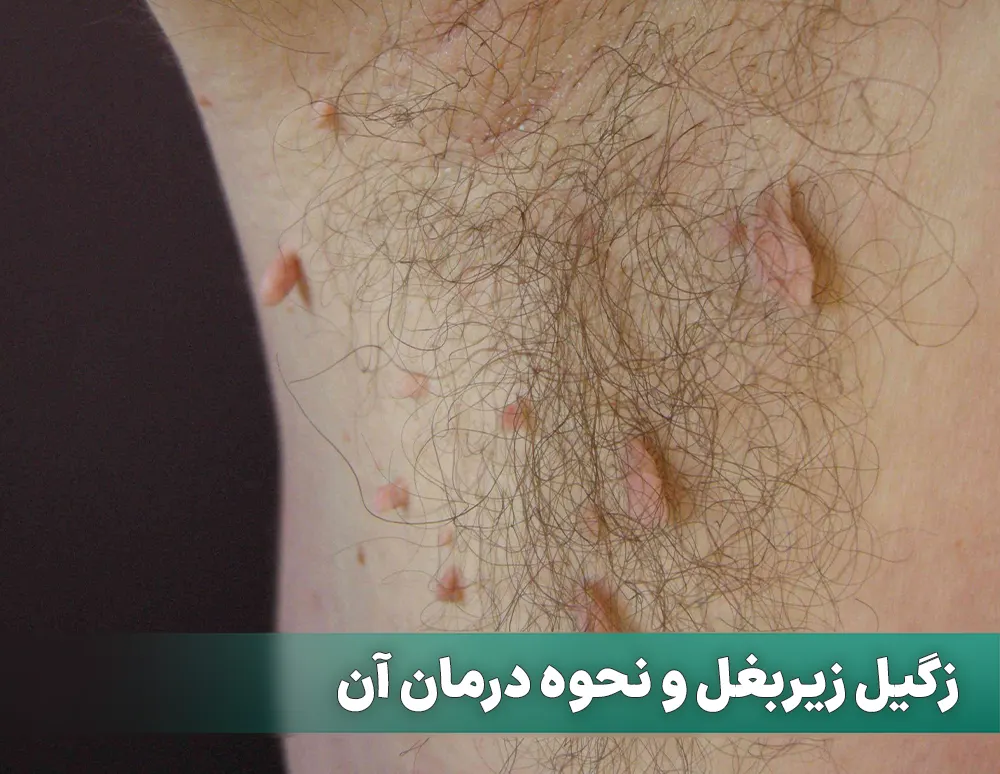 زگیل زیر بغل