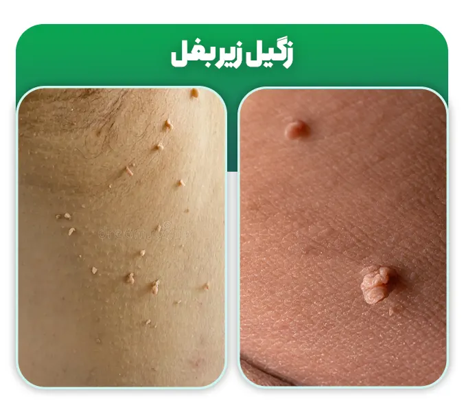 زگیل زیر بغل