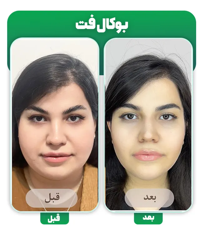 قبل و بعد بوکال فت