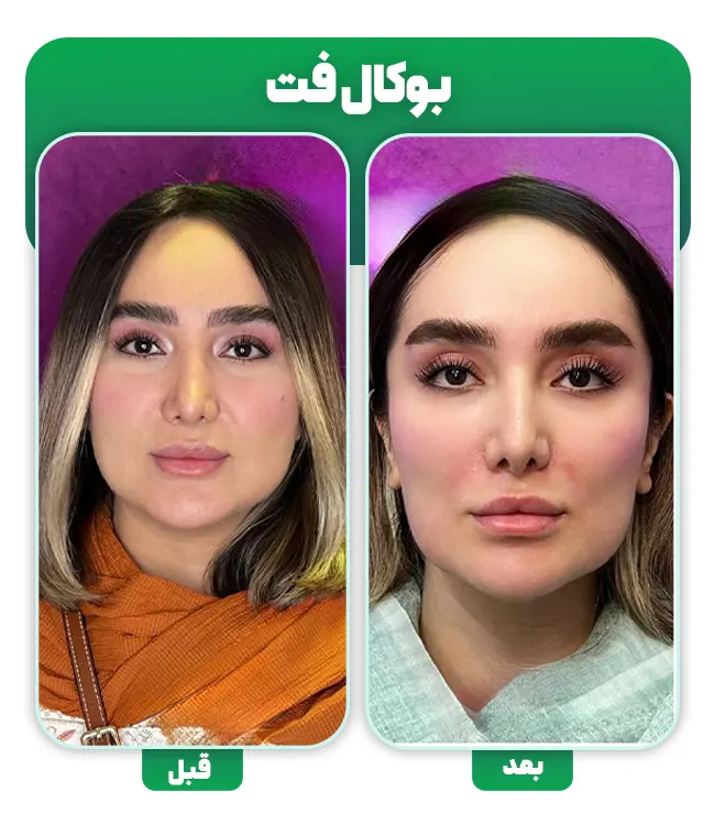 قبل و بعد بوکال فت