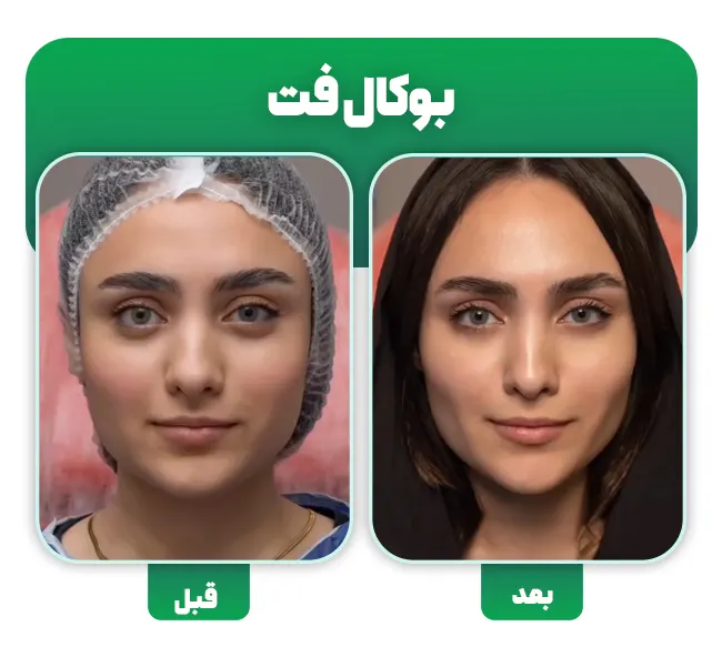 جراحی بوکال فت