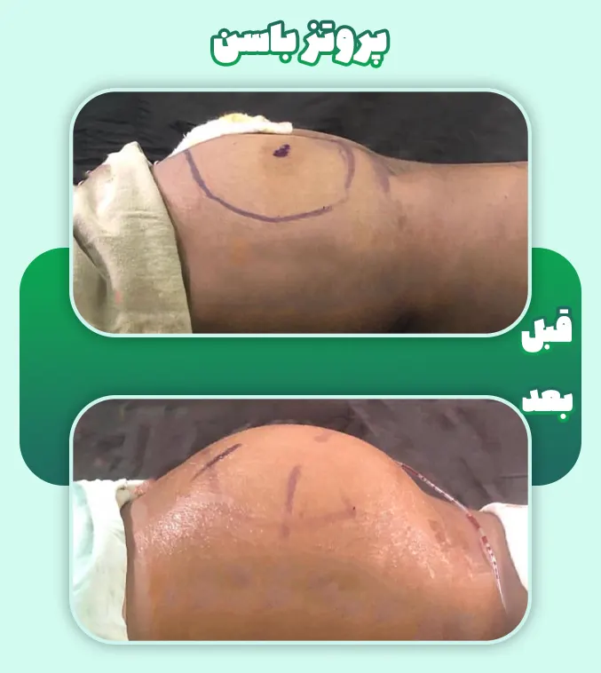 پروتز باسن قبل و بعد