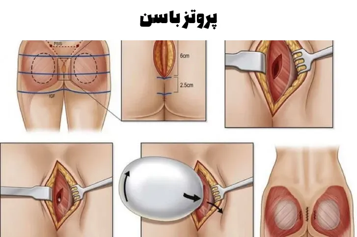 پروتز باسن
