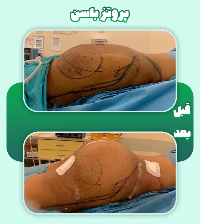پروتز باسن قبل و بعد
