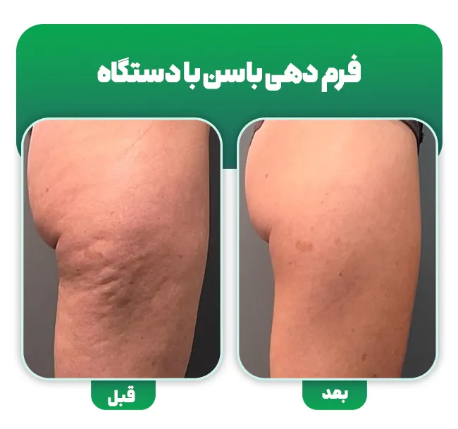 فرم دهی باسن با دستگاه