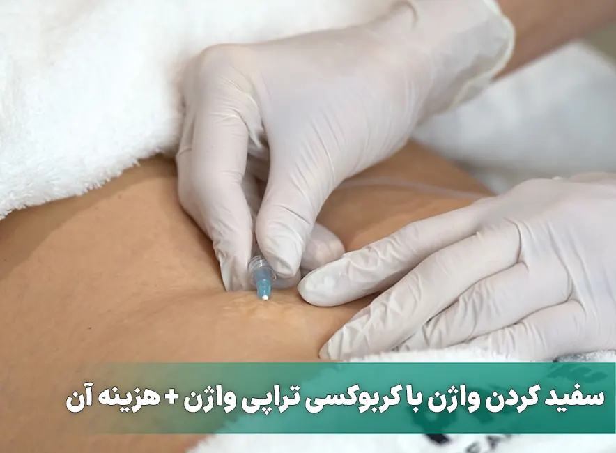 روشن و سفید کردن واژن با کربوکسی تراپی واژن