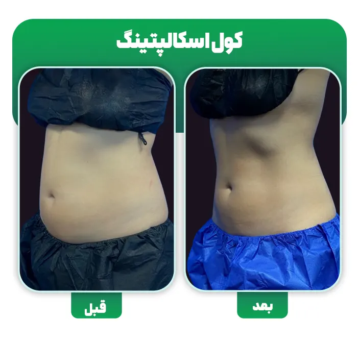 لاغری با کول اسکالپتینگ