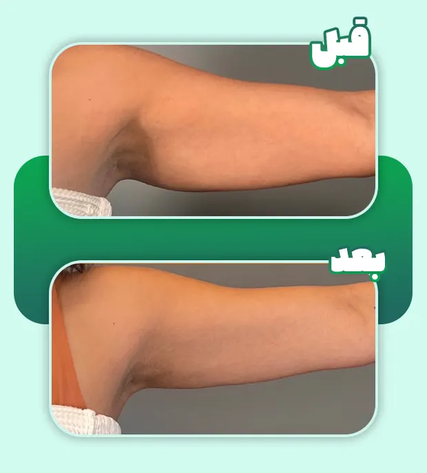 لاغری با کول اسکالپتینگ