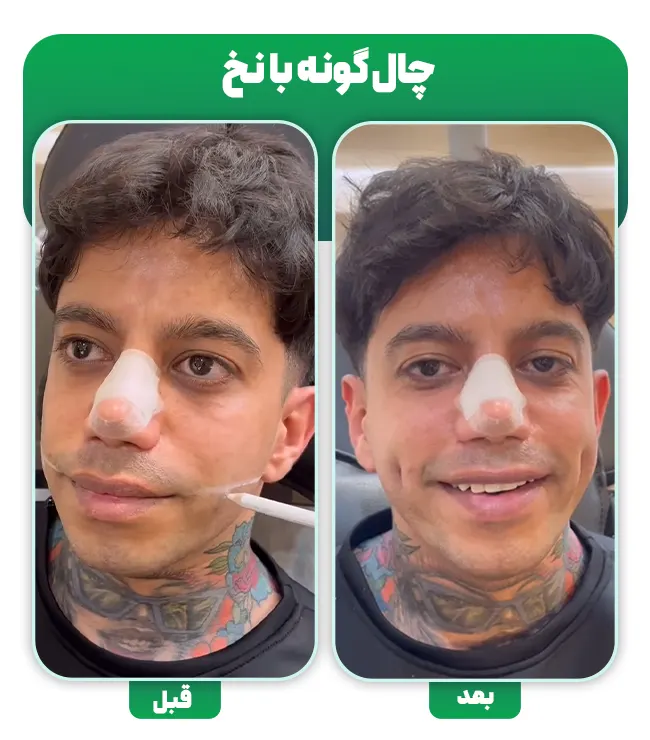 قبل و بعد چال گونه