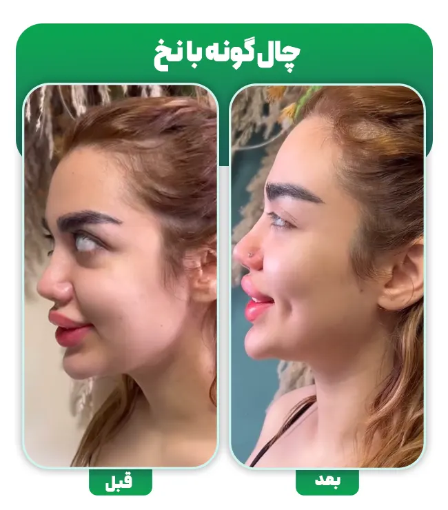 قبل و بعد چال گونه