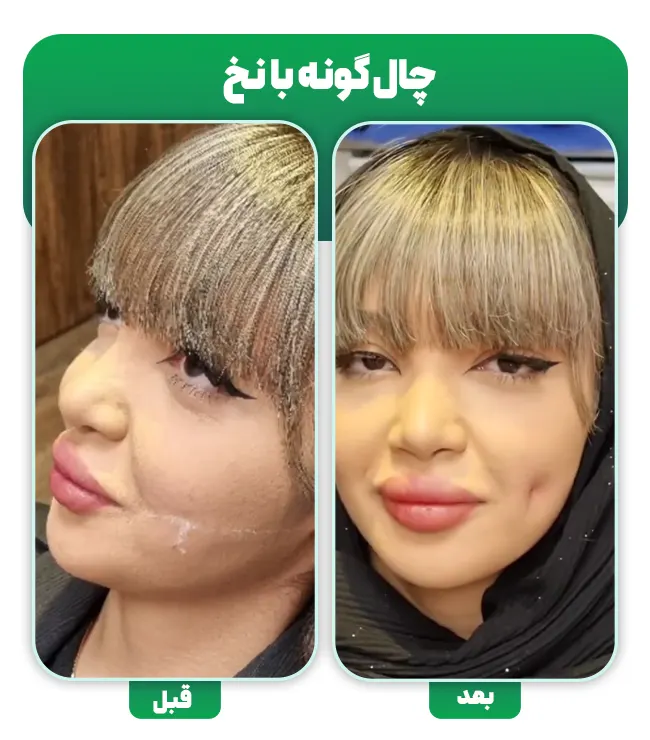 روش های ایجاد چال گونه