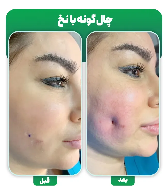 قبل و بعد چال گونه