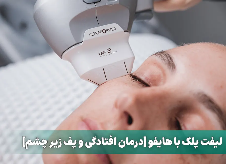 درمان افتادگی پلک با هایفو