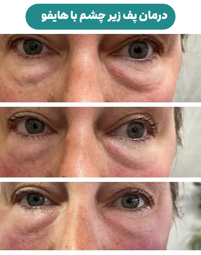 درمان پف زیر چشم با هایفو