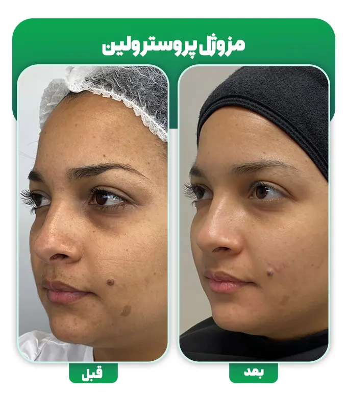 قبل و بعد مزوژل پروسترولین