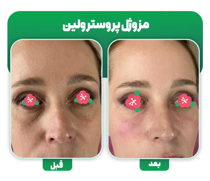 قبل و بعد مزوژل پروسترولین
