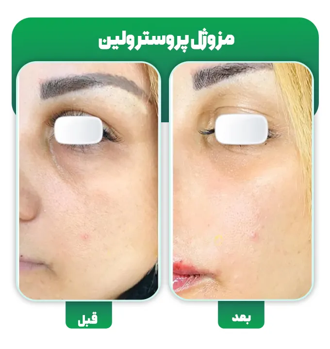 قبل و بعد مزوژل پروسترولین