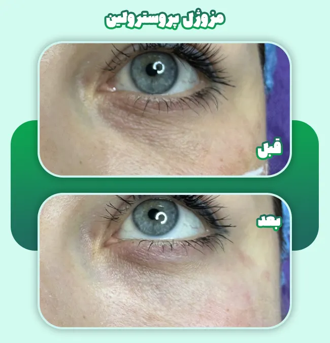 قبل و بعد مزوژل پروسترولین