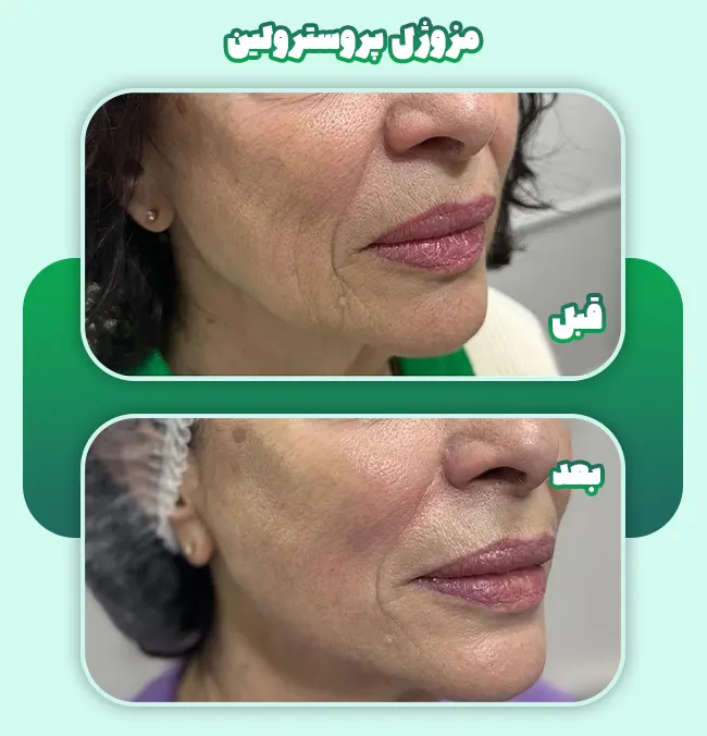 قبل و بعد مزوژل پروسترولین