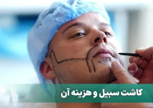 کاشت سبیل و هزینه آن