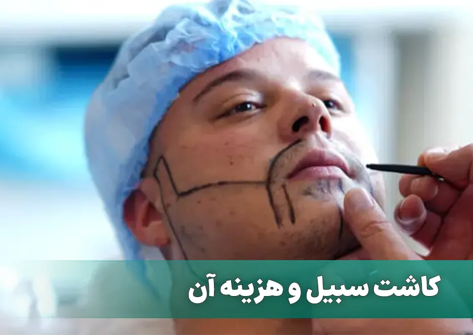 کاشت سبیل و هزینه آن