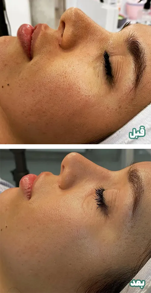 درمان منافذ باز پوست با آر اف فرکشنال