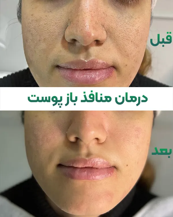 درمان منافذ باز پوست با آر اف فرکشنال