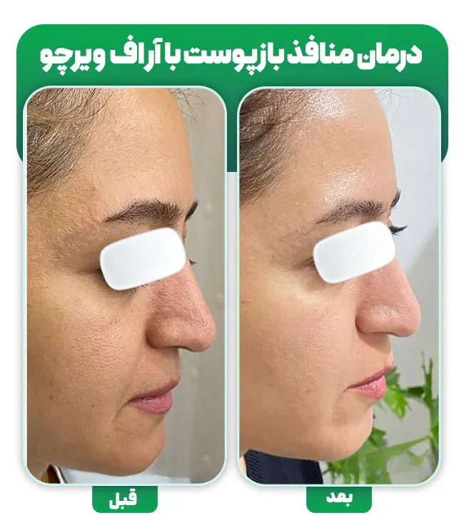 درمان منافذ باز پوست با آر اف فرکشنال ویرچو