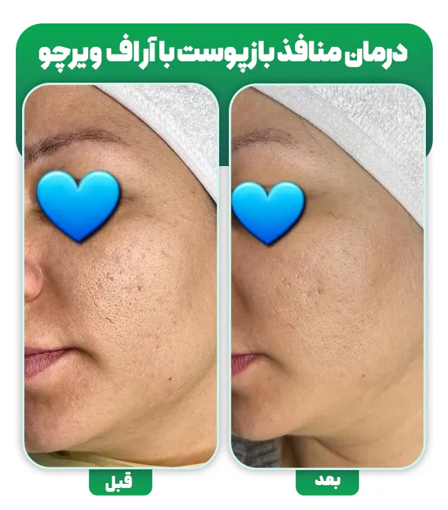 درمان منافذ باز پوست با آر اف فرکشنال ویرچو