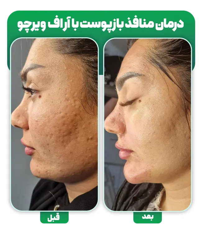 درمان منافذ باز پوست با آر اف فرکشنال ویرچو