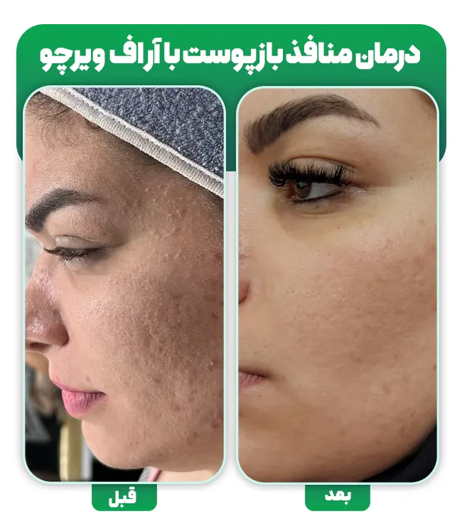 قبل و بعد درمان منافذ باز پوست با آر اف فرکشنال