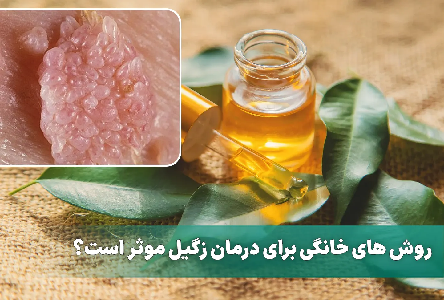 درمان های خانگی برای زگیل تناسلی موثر هستند