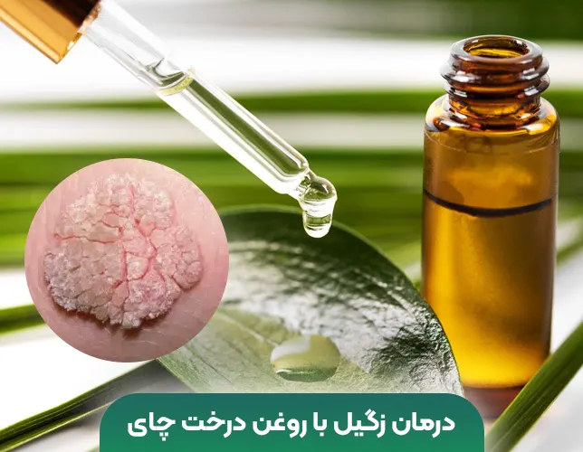 درمان زگیل روغن درخت چای
