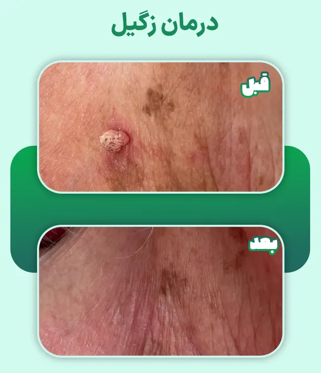 قبل و بعد درمان زگیل