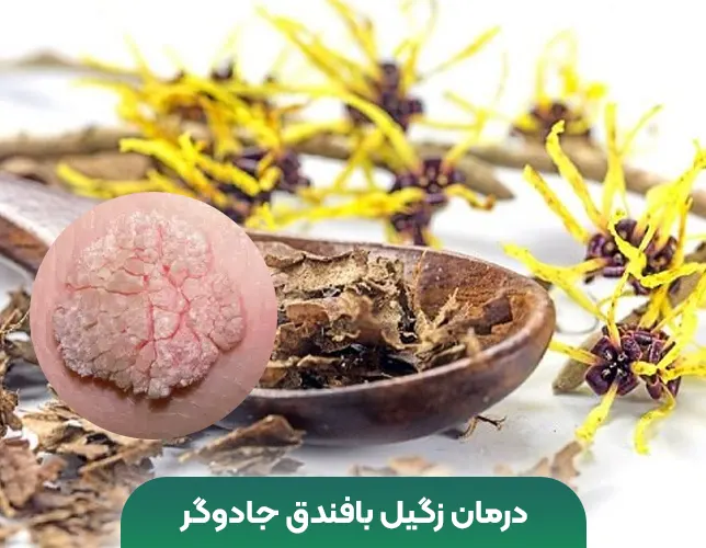 درمان زگیل فندق جادوگر