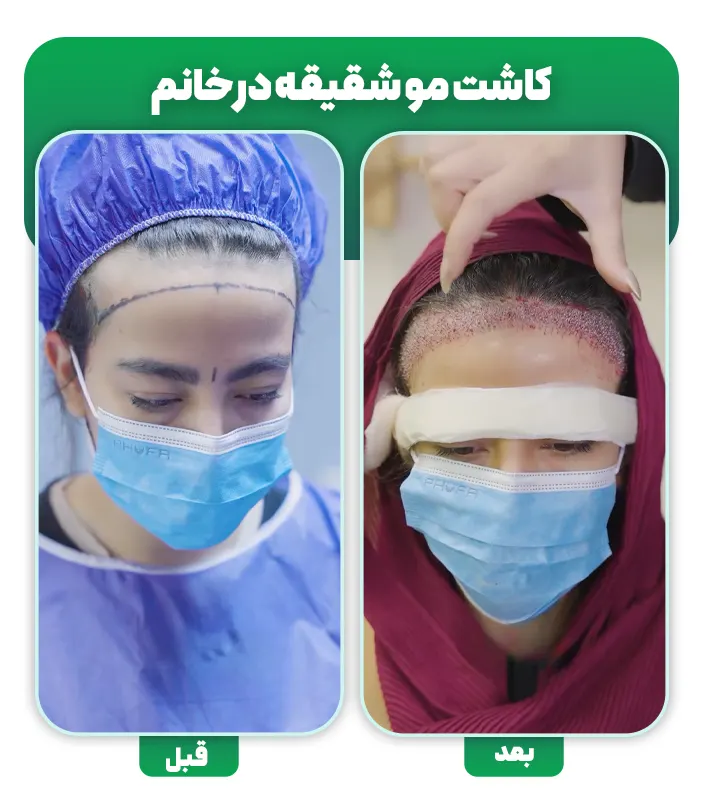 کاشت مو شقیقه در خانم ها