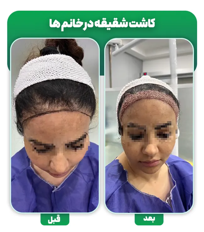 کاشت مو شقیقه در خانم ها