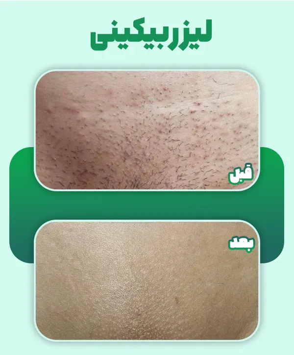 لیزر بیکینی قبل بعد