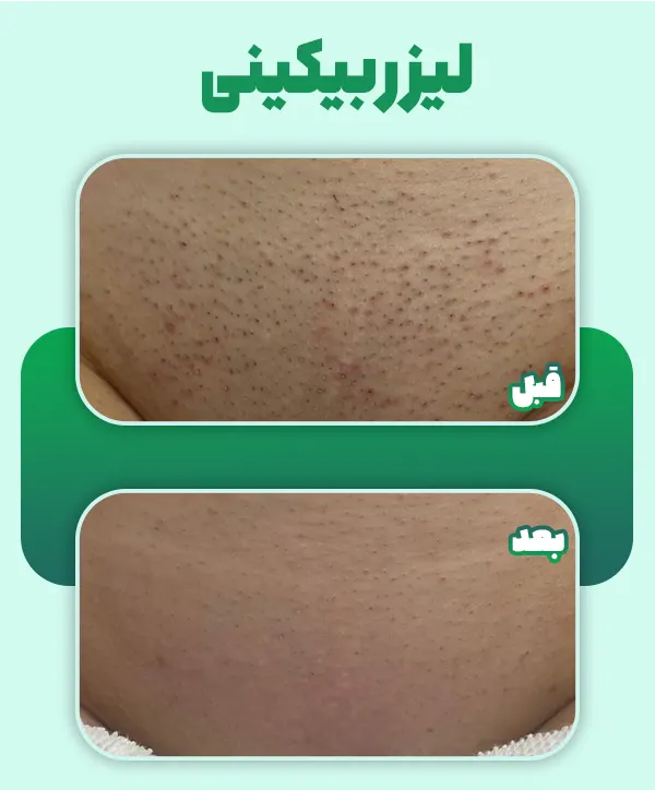 لیزر بیکینی قبل بعد